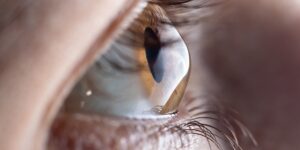 Barraquer Eye Hospital UAE Launches “We Care” Initiative to Raise Awareness About Keratoconus and Promote Early Detection